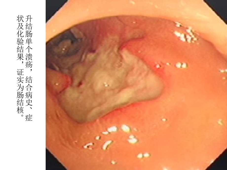 腹部结核多媒体.ppt_第3页