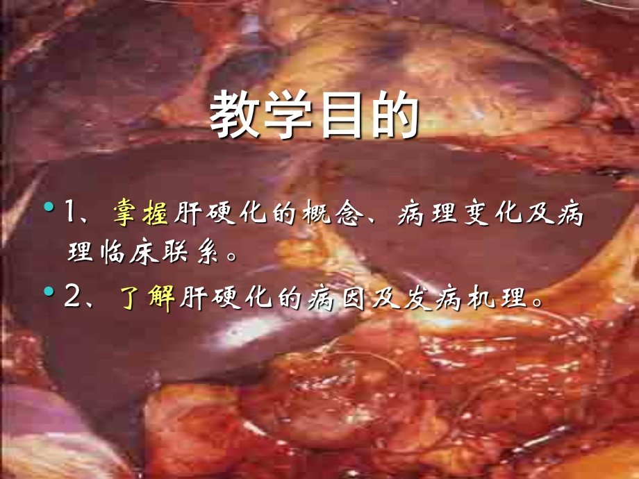 肝硬化公开教学.ppt_第2页