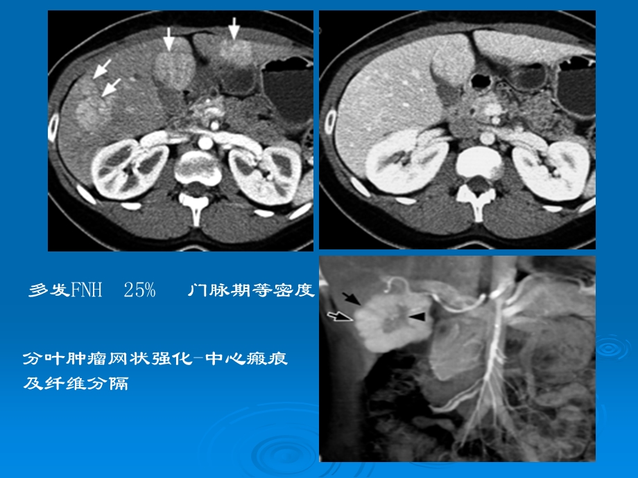 肝脏少见病变和征象.ppt_第3页