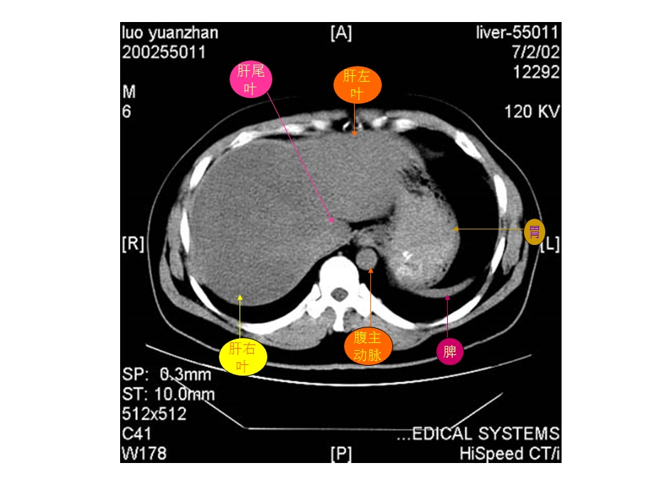 腹部CT解剖图示.ppt_第3页