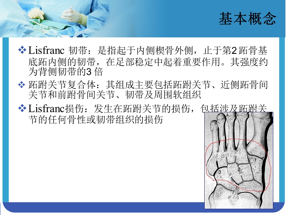 lisfranc损伤ppt课件.ppt_第3页