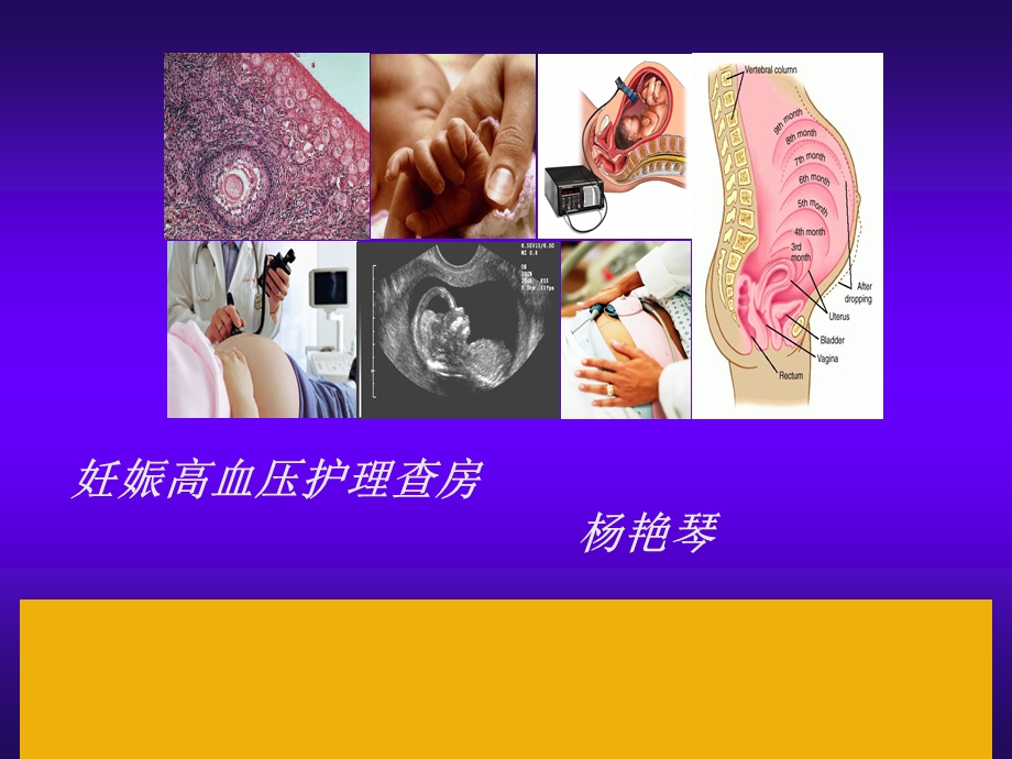 妊娠高血压护理查房新.ppt_第1页