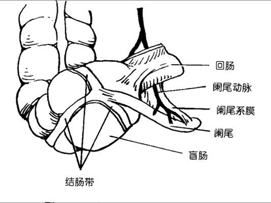 急性阑尾炎(一点通).ppt_第3页