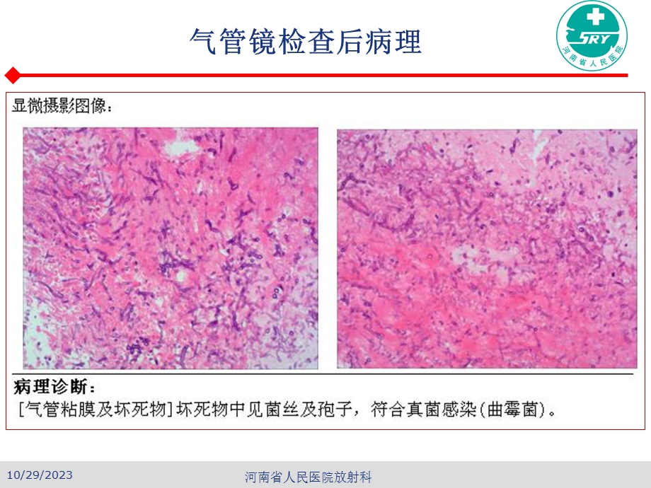 曲霉菌病的诊断ppt课件.ppt_第3页