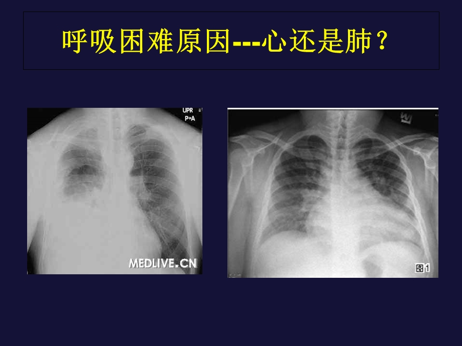 慢心衰患者血气和代谢变化.ppt_第3页