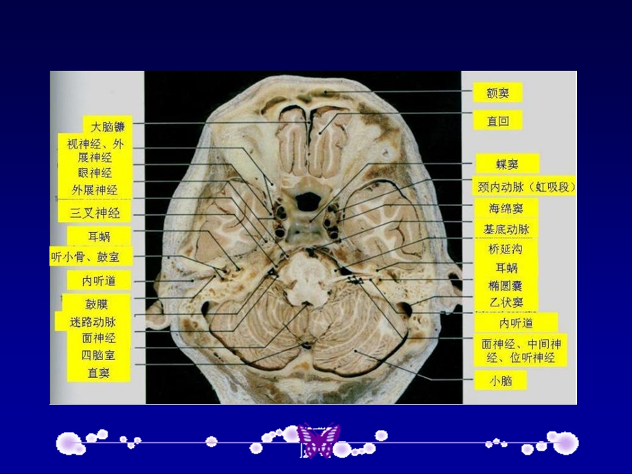 桥小脑角区病变影像诊断.ppt_第3页