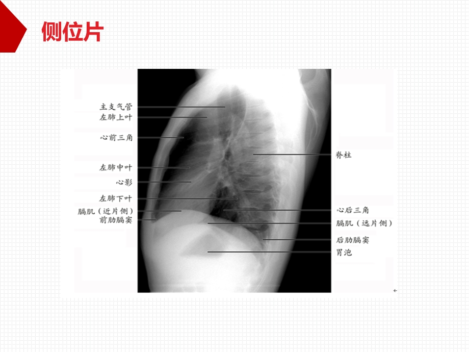 胸片基础知识.ppt_第3页