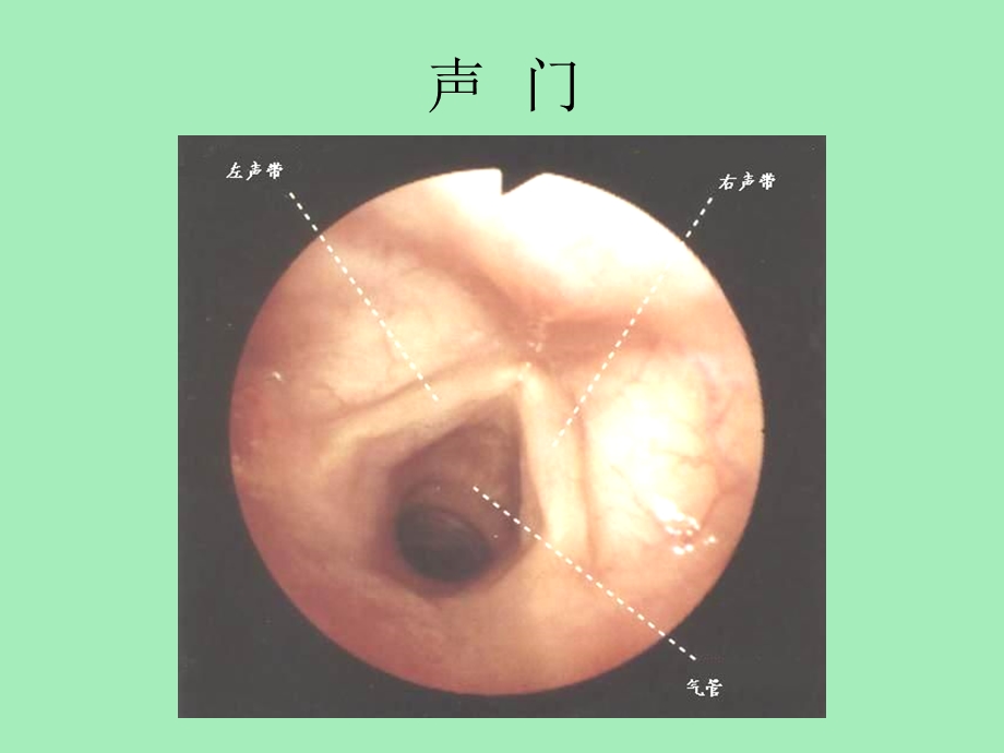 气管镜图谱复.ppt_第3页