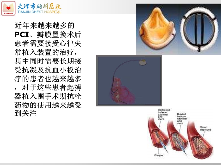 起搏器围术期抗凝药物应用的新观点.ppt_第2页