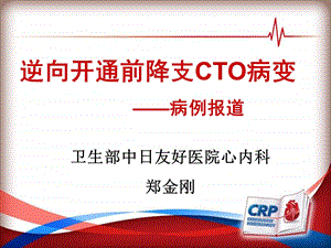 逆向开通前降支CTO病变-病例报道.ppt