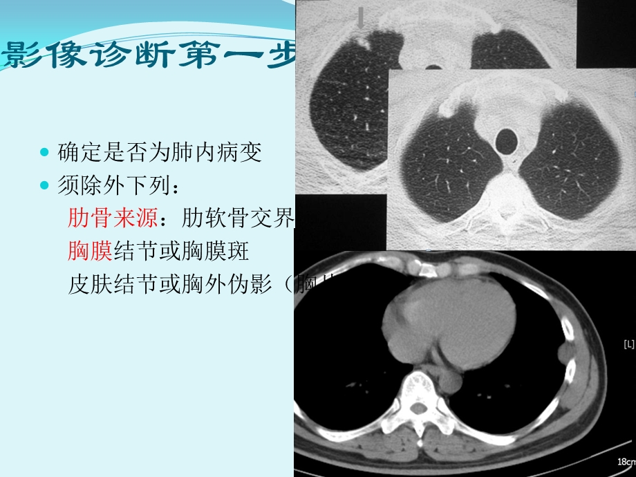 胸部CT肺内孤立性结节.ppt_第3页