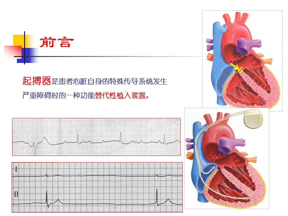 起搏器计时间期的意义.ppt_第2页