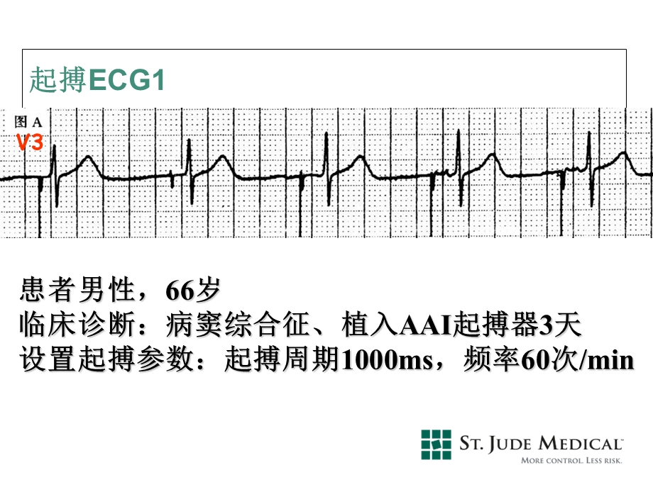 起搏心电图实例分析.ppt_第3页