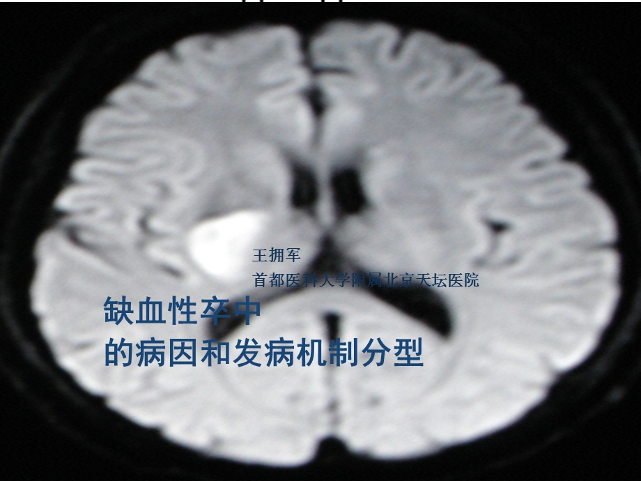 缺血性卒中的病因和发病机制分型.ppt_第1页