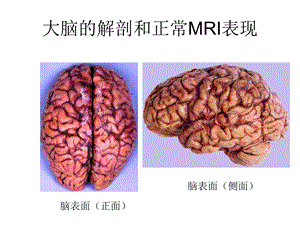 大脑的解剖和正常mri表现.ppt