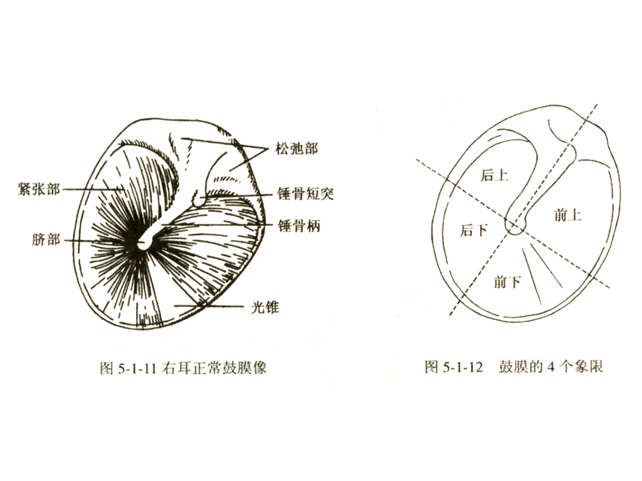 化脓性中耳炎及其并发症新.ppt_第3页