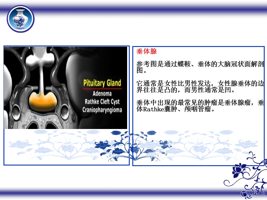 垂体及周围解剖及疾病.ppt_第3页