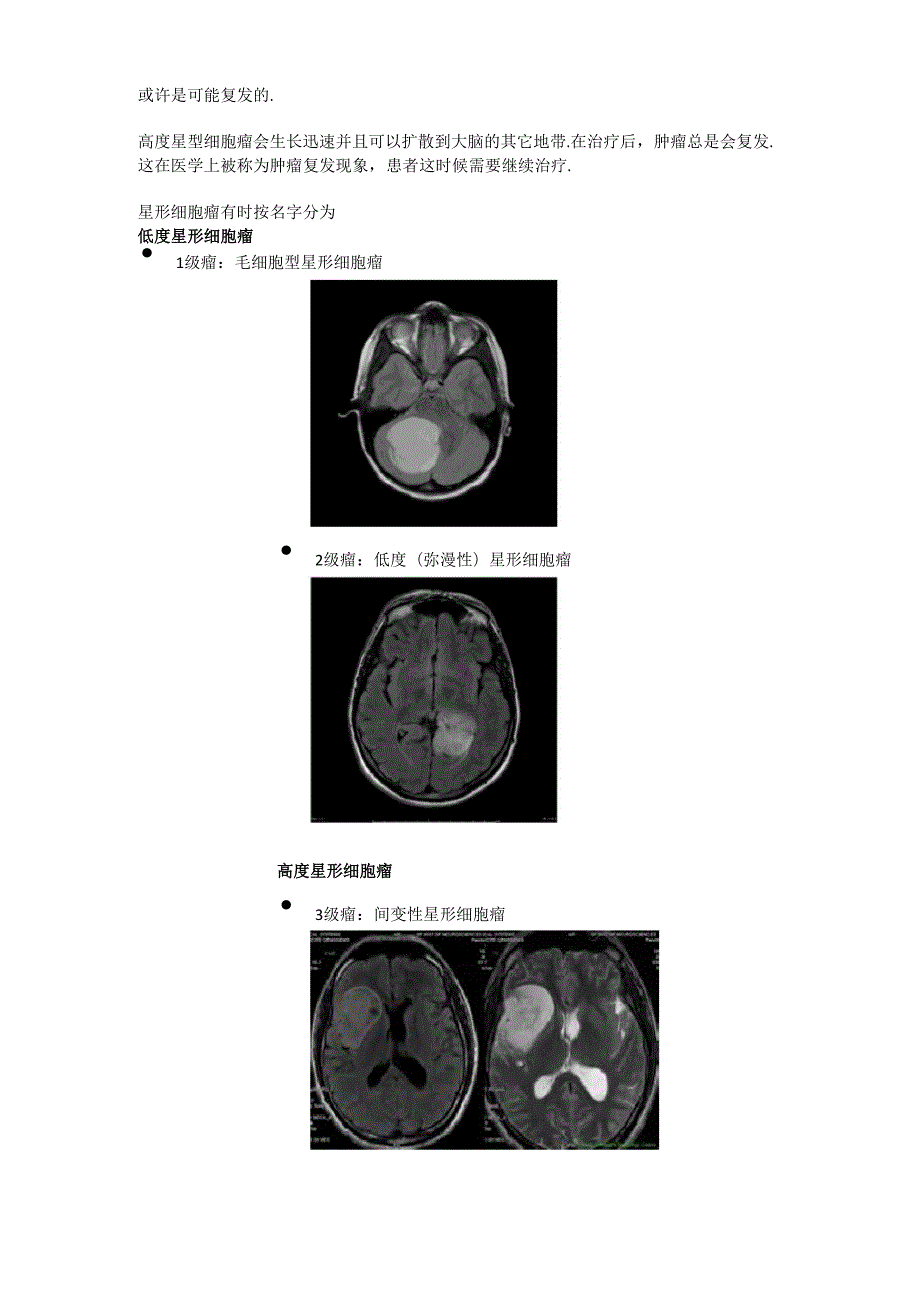 星形细胞瘤质子治疗.docx_第2页