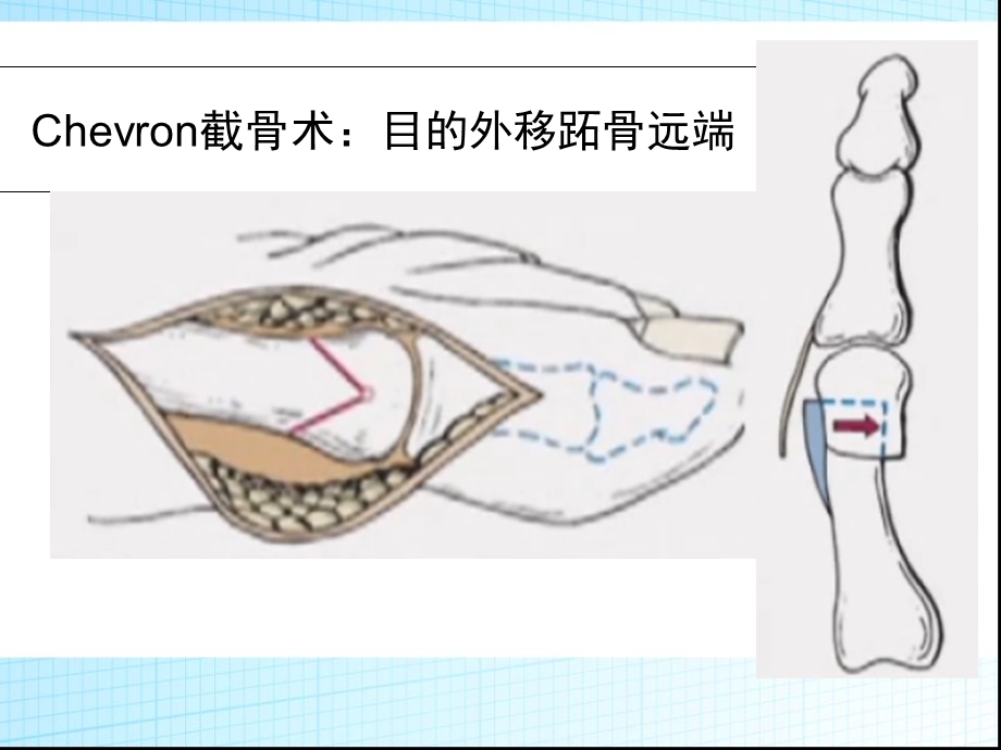 改良Chevron截骨.ppt_第2页