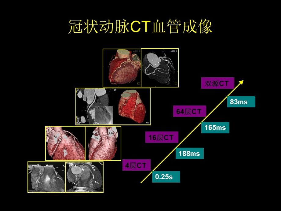多排螺旋CT在冠状动脉成像中的应用.ppt_第3页