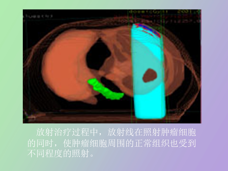 放射治疗技术.ppt_第3页