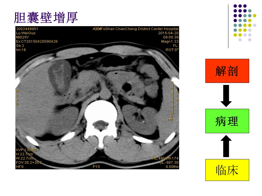 胆囊壁弥漫性增厚的临床、病理与影像.ppt_第2页