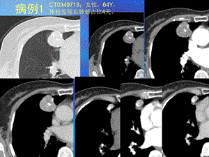 肺部错构瘤ct鉴别诊断病例随访.ppt