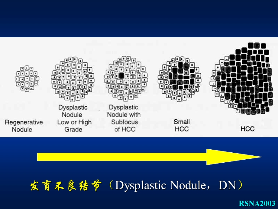 肝脏发育不良结节癌变的mri评价.ppt_第3页