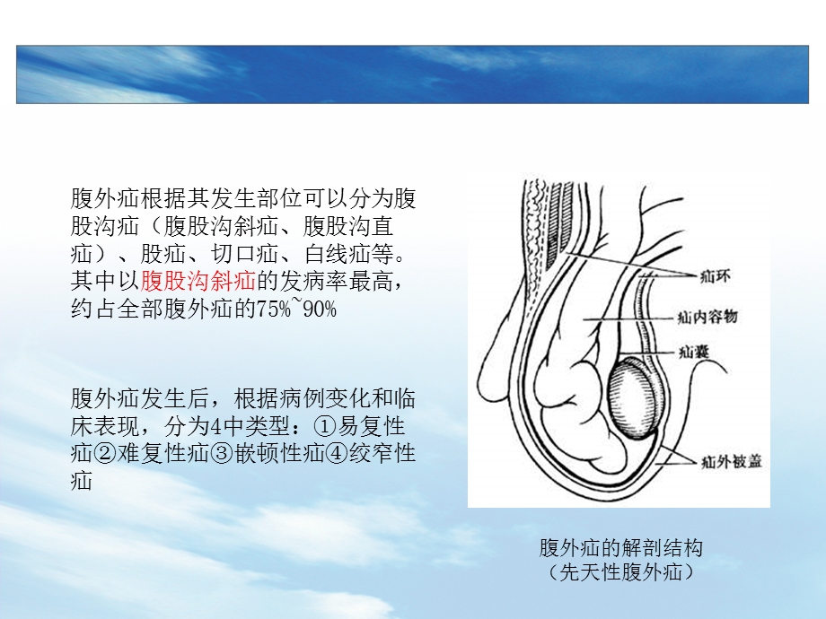 腹外疝的体格检查.ppt_第3页