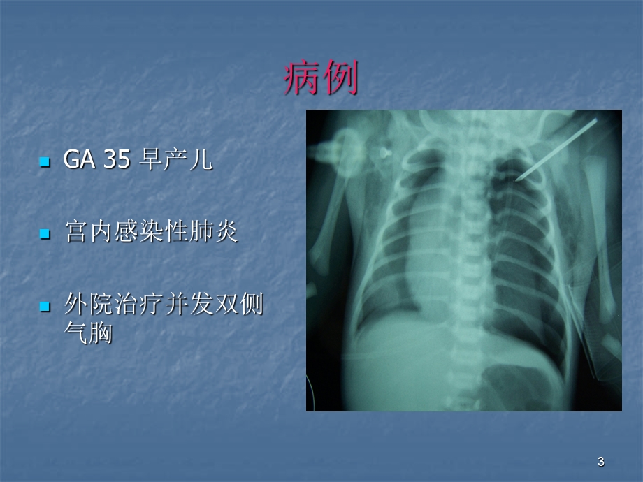 高频通气PPT课件.ppt_第3页