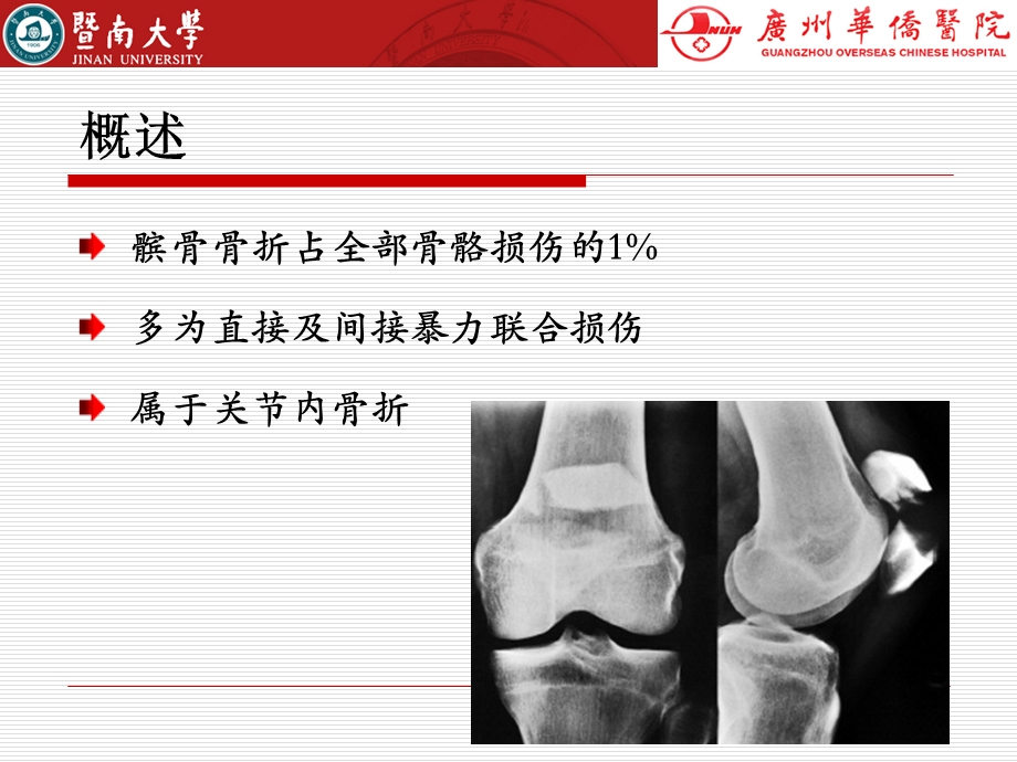 髌骨骨折不同内固定方式及选择.ppt_第2页