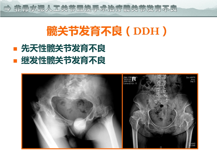 非骨水泥人工关节置换手术治疗髋臼发育不良.ppt_第2页