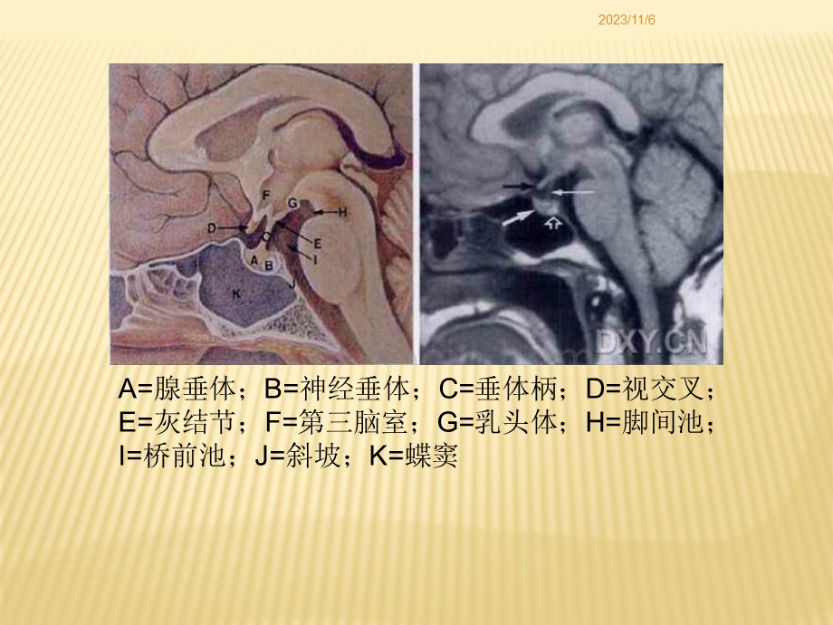 鞍区病变的鉴别诊断-和术.ppt_第3页