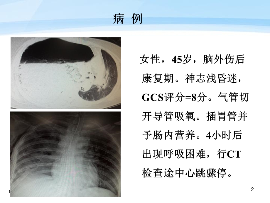 高频通气临床应用体会马新华.ppt_第2页