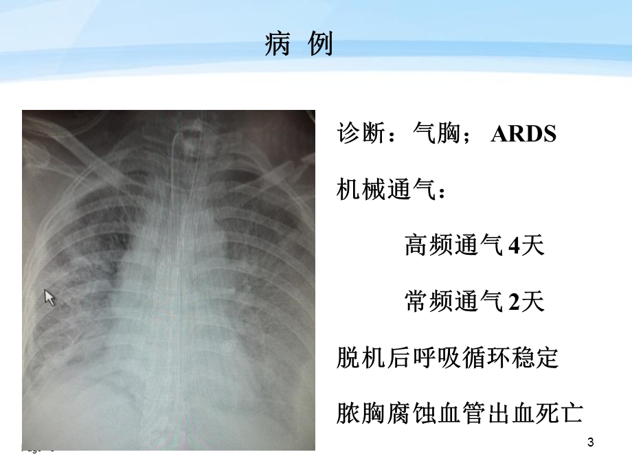 高频通气临床应用体会马新华.ppt_第3页