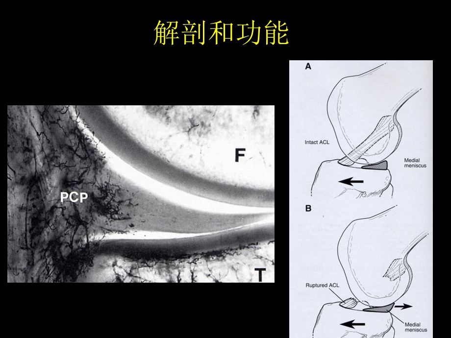 半月板损伤的关节镜技术中.ppt_第3页