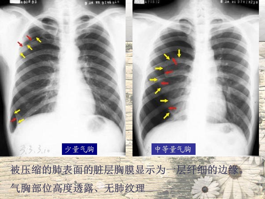 呼吸系统常见疾病影像学表现.ppt_第3页