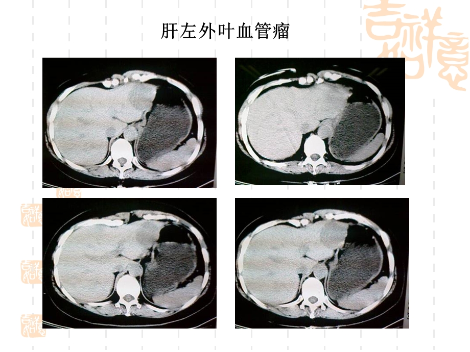 腹腔镜下左肝外叶血管瘤切除术.ppt_第3页