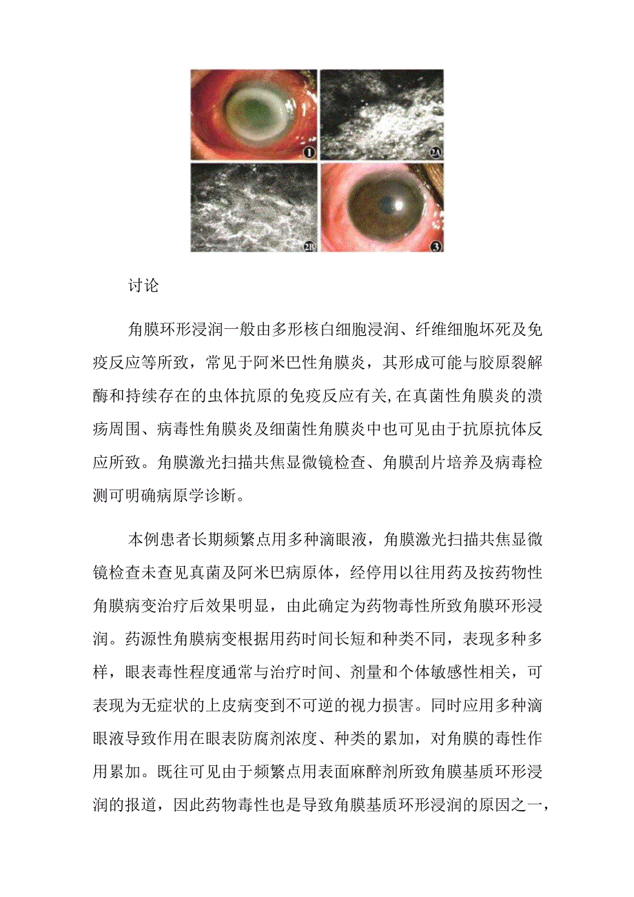 眼科医师晋升副主任（主任）医师高级职称病例分析专题报告（药物性角膜环形浸润）.docx_第3页