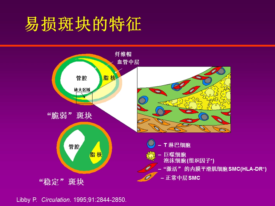 急性心肌梗死的治疗原则PPT课件.ppt_第3页