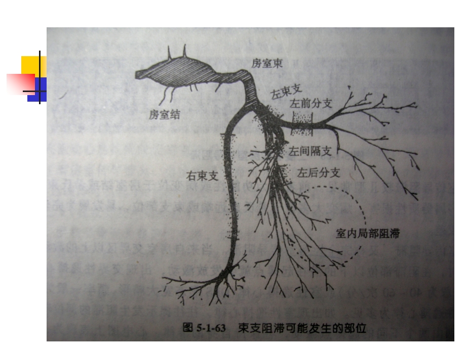 常见心律失常的心电图表现与解读.ppt_第3页