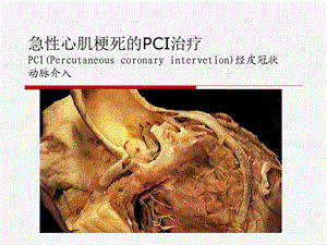 急性心肌梗死的PCI治疗.ppt