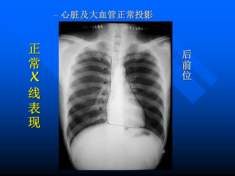 心脏常规x线检查.ppt_第3页