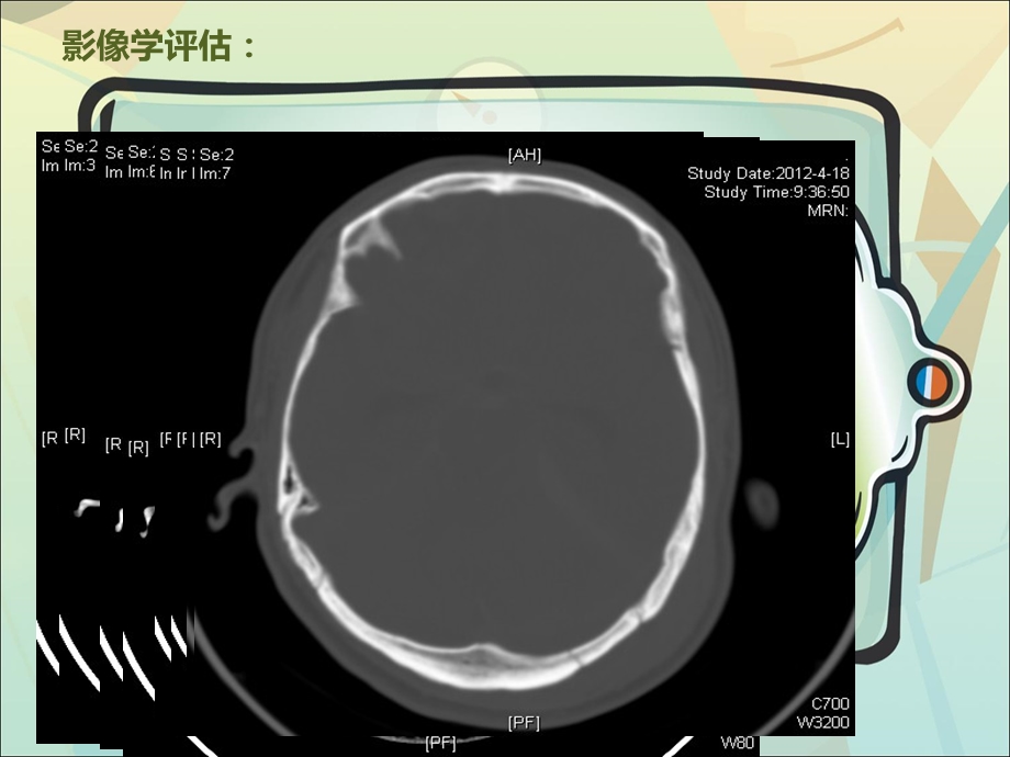 颅内压监测病例分享.ppt.ppt.ppt_第3页