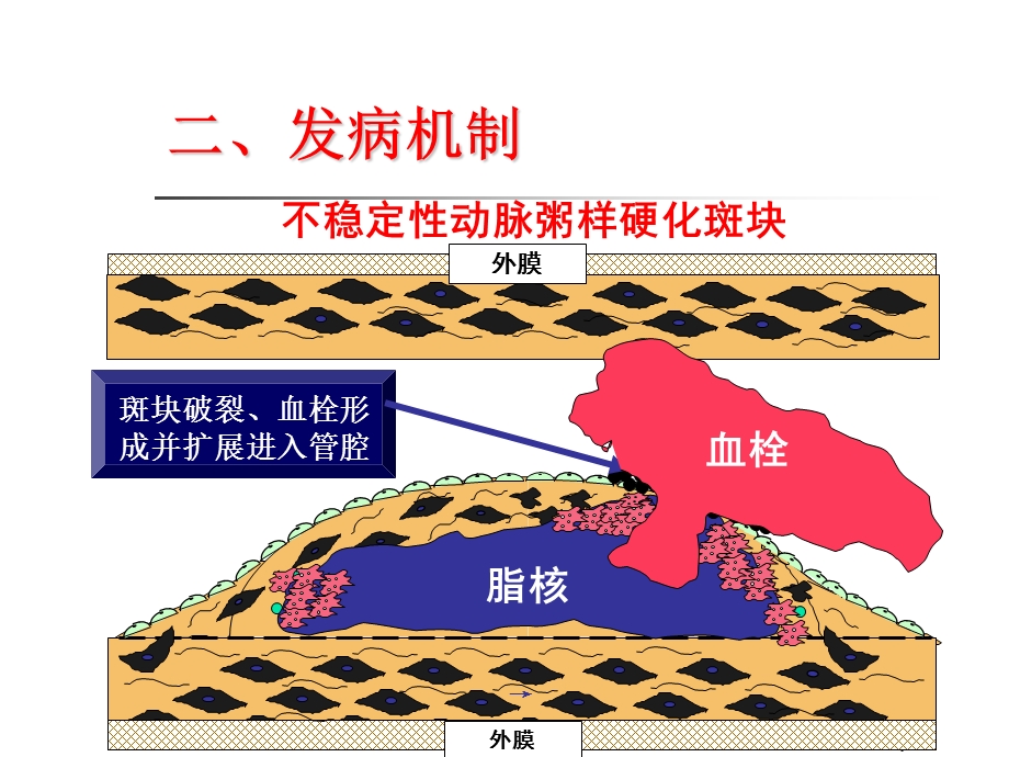 急性心肌梗死新PPT课件.ppt_第3页