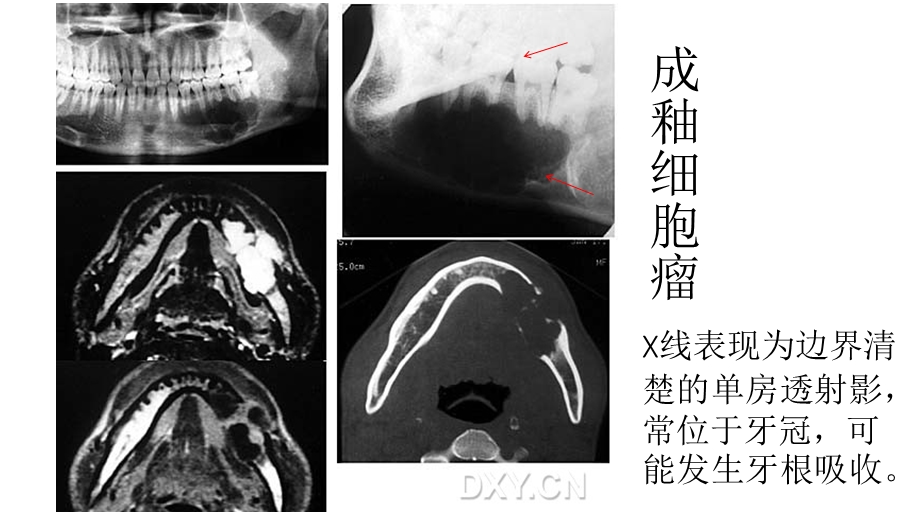 常见的口腔病例影像.ppt_第2页