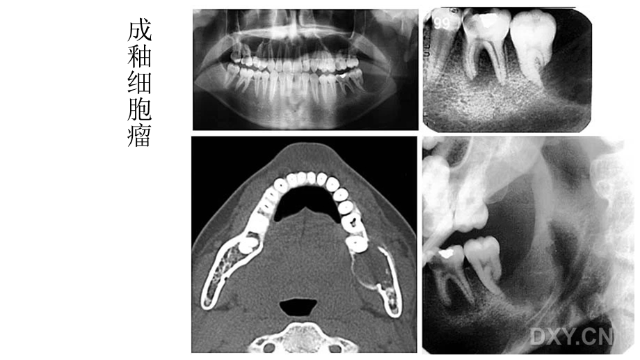 常见的口腔病例影像.ppt_第3页