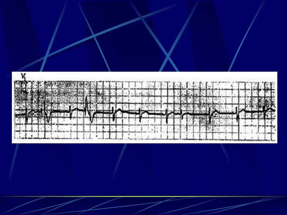 常见心律失常的心电图表现.ppt_第3页