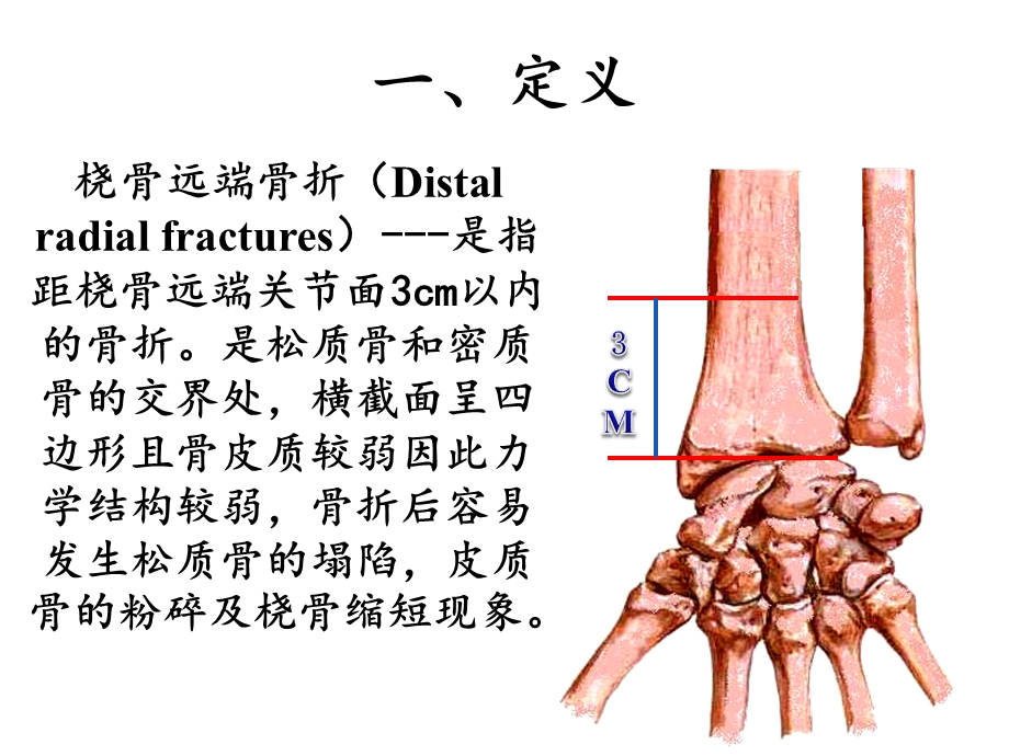 桡骨远端骨折教学查房.ppt_第2页