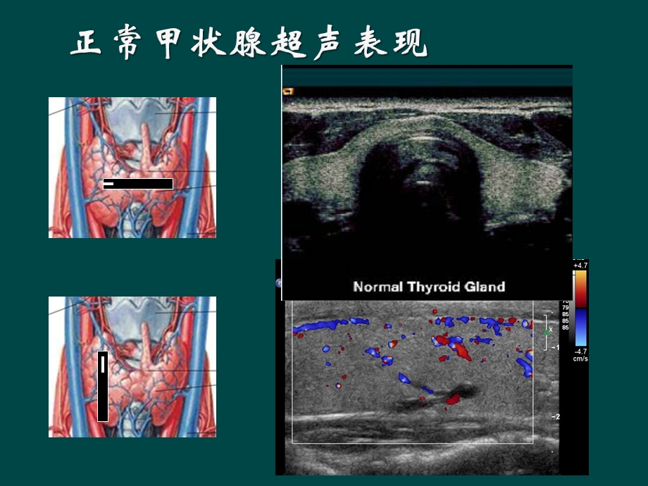 甲状腺癌的超声检查.ppt_第2页